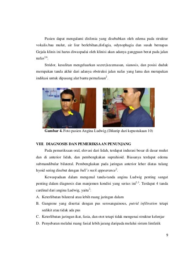 angina ludwig adalah